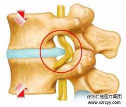 【脊柱】腰突不看年齡，生活習(xí)慣是關(guān)鍵！