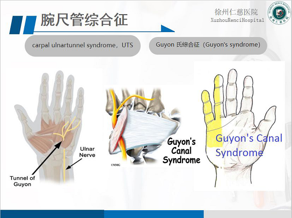 腕尺管綜合征