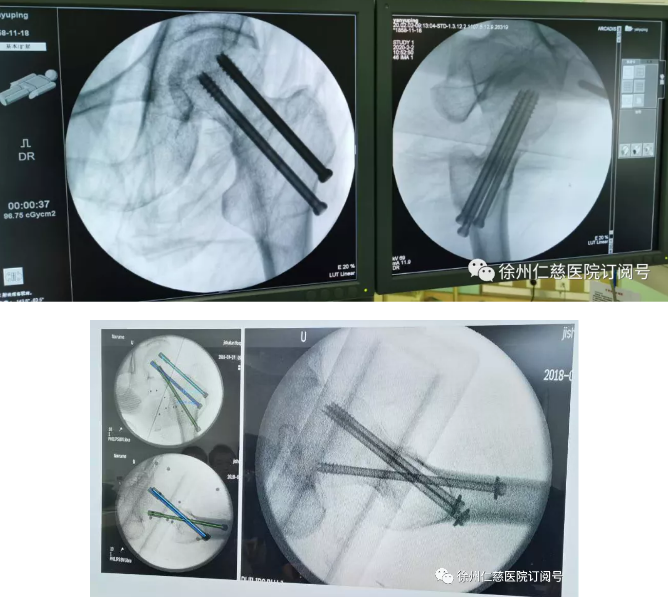 徐州仁慈醫(yī)院骨科機器人