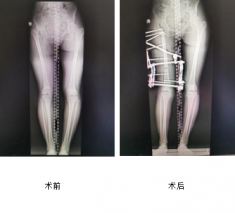 花季少女跛行15年，仁慈骨科利用Ilizarov技術幫其健康行走