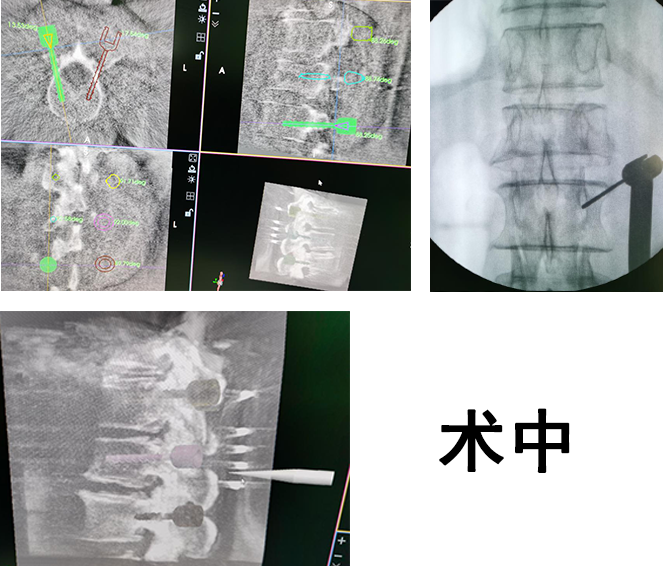 骨科機(jī)器人