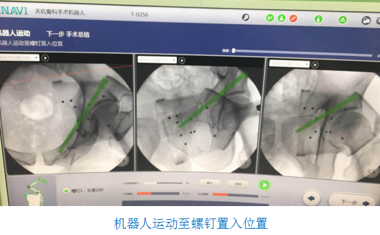 骨科機(jī)器人