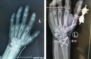 男子被鐵器砸傷，左手五處骨折，骨科機器人、腕關節(jié)鏡同上手術臺