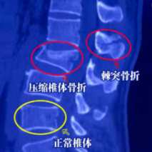 天璣骨科機器人輔助骨科微創(chuàng)手術 5個“小孔”修復腰椎骨折